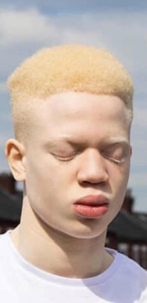 Albino Eyes Shut